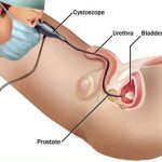 Flexible-Cystoscopy