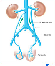 varicocele